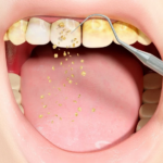 Điều gì xảy ra khi không lấy cao răng?